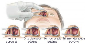 burun eti büyümesi